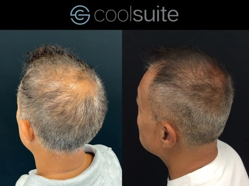 Roots Genesis at Templus Life clinic in Richmond BC